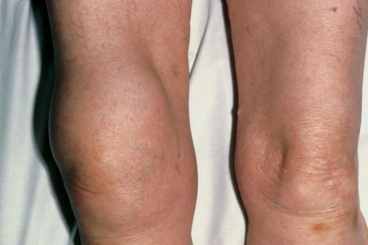 慢性劳损软组织发炎肿胀图