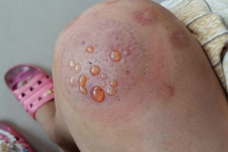 拔罐罐印有水泡图