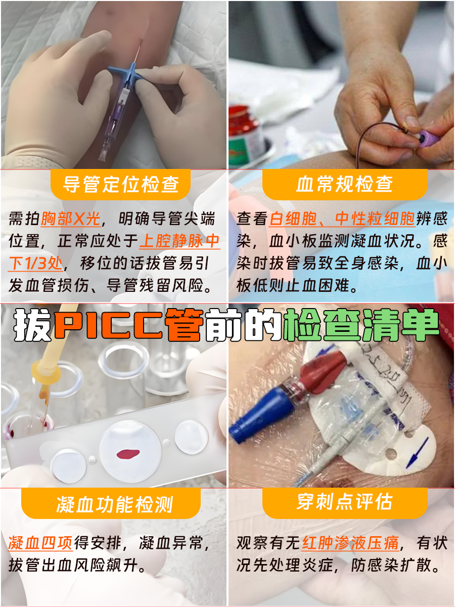 拔PICC管前，这些检查你真的做全了吗？