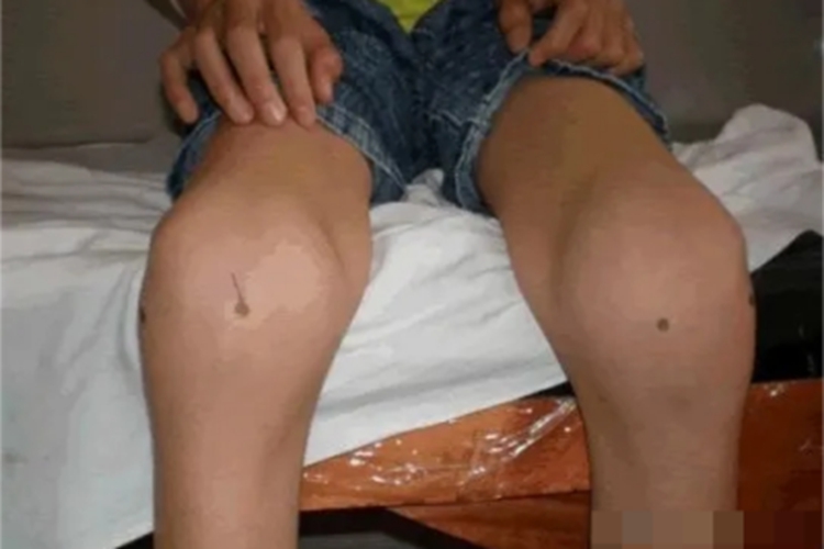 血友病A膝盖肿图