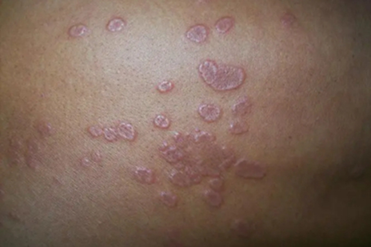 扁平苔藓样药疹背部红斑图