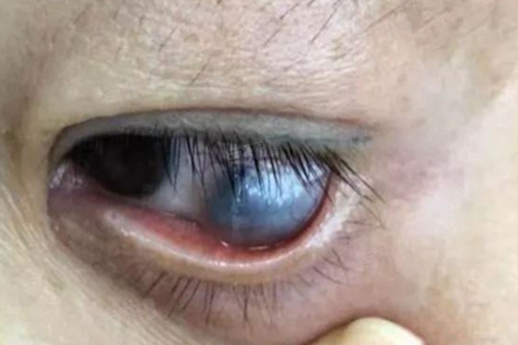 高度近视后巩膜葡萄肿