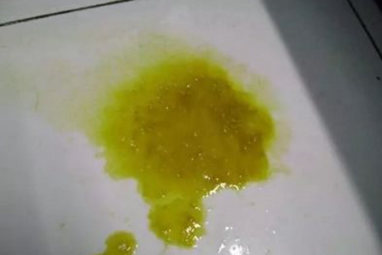 黄绿色水样便图