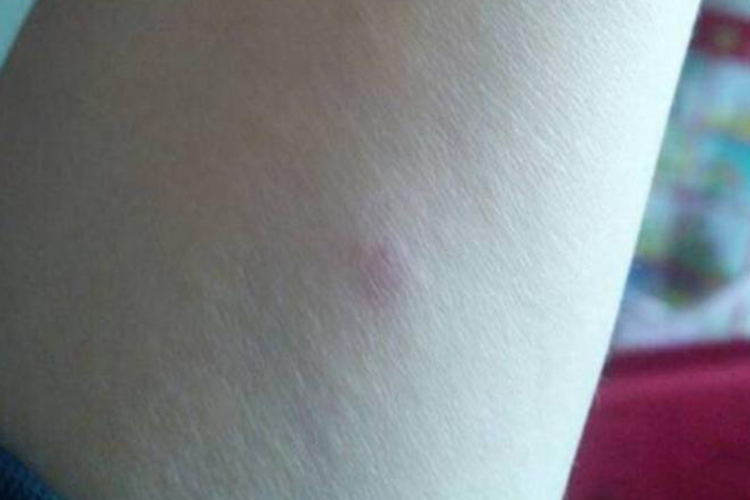 皮试结果正常图