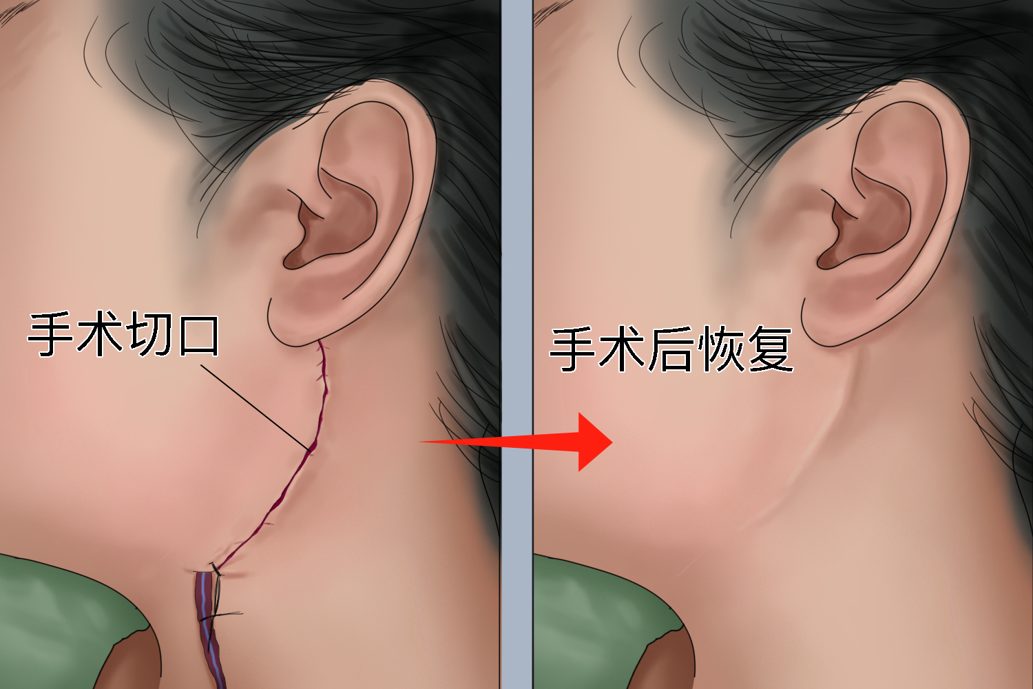 腮腺切除术后恢复图片