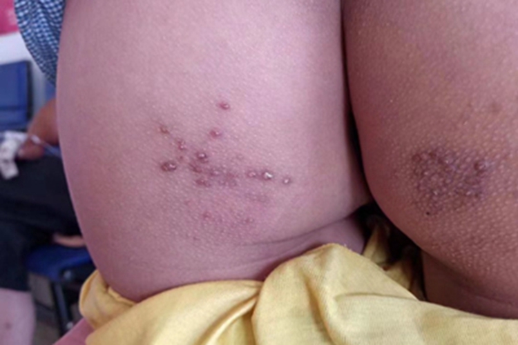 慢性湿疹臀部疙瘩图 慢性湿疹臀部疙瘩图