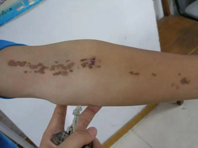 汗孔角化病胳膊上长了一串褐色斑图.jpg