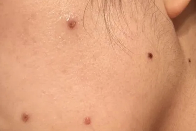 男士冷冻点痣图