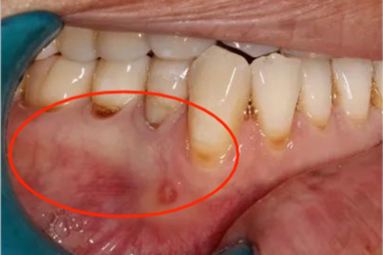 急性坏死性龈口炎牙龈脓肿图 急性坏死性龈口炎牙龈脓肿图