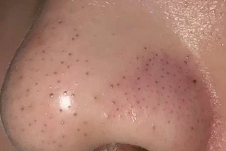 黑头鼻头上有黑点图