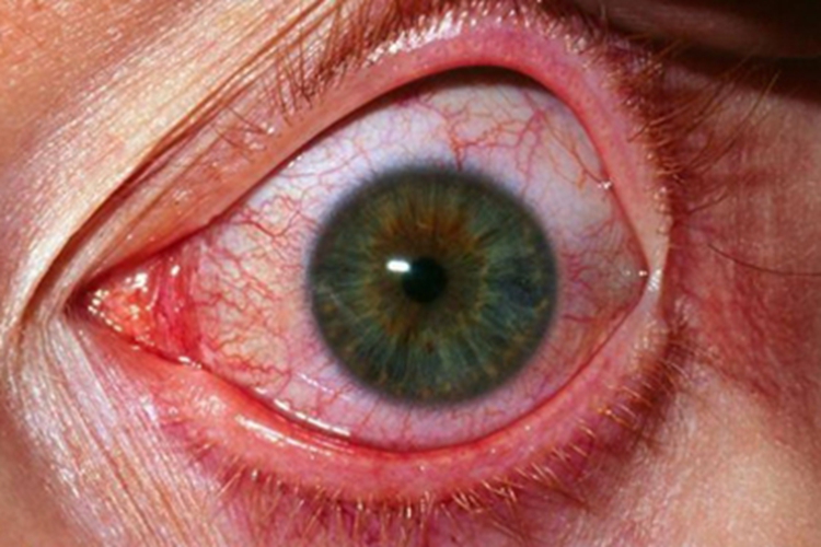 梅毒眼睛红症状图片图片
