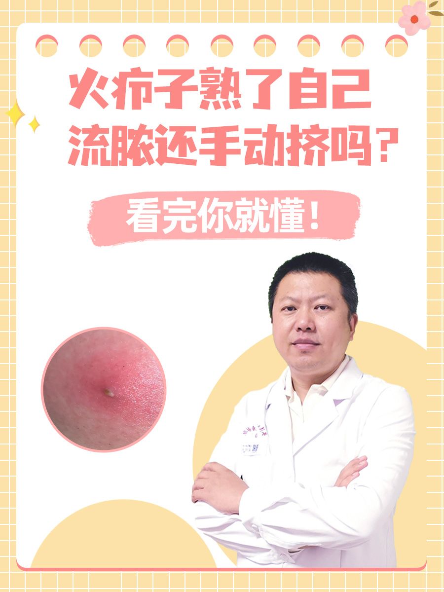 火疖子熟了自己流脓还手动挤吗?看完你就懂!