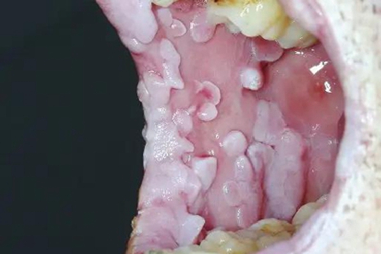 艾滋病感染性皮肤损害肉赘图