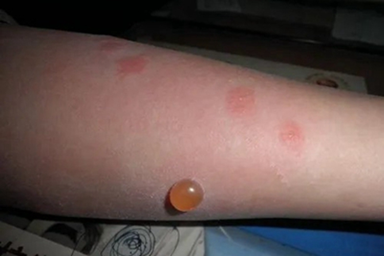 蚋叮咬引起的皮肤反应大水疱图 蚋叮咬引起的皮肤反应大水疱图