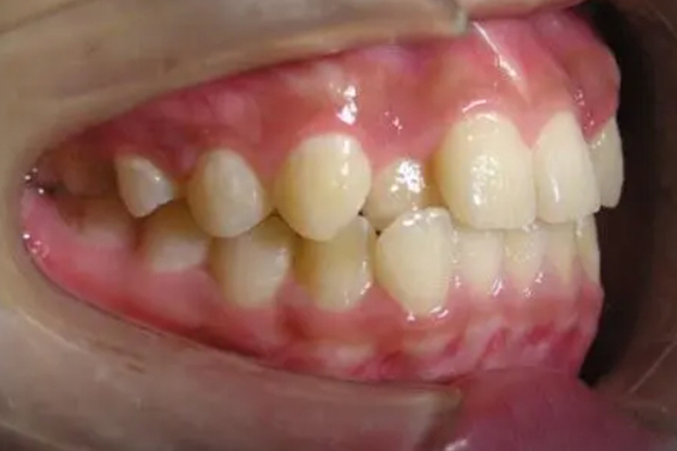 上下牙床均错位图 上下牙床均错位图