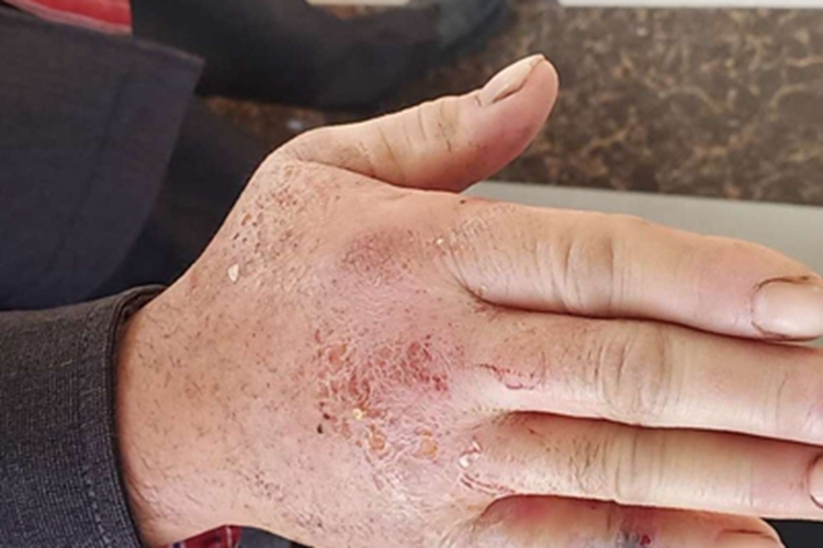 蝎蜇伤结痂图 蝎蜇伤结痂图