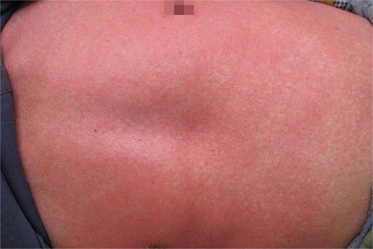 猩红热型药疹图 猩红热型药疹图