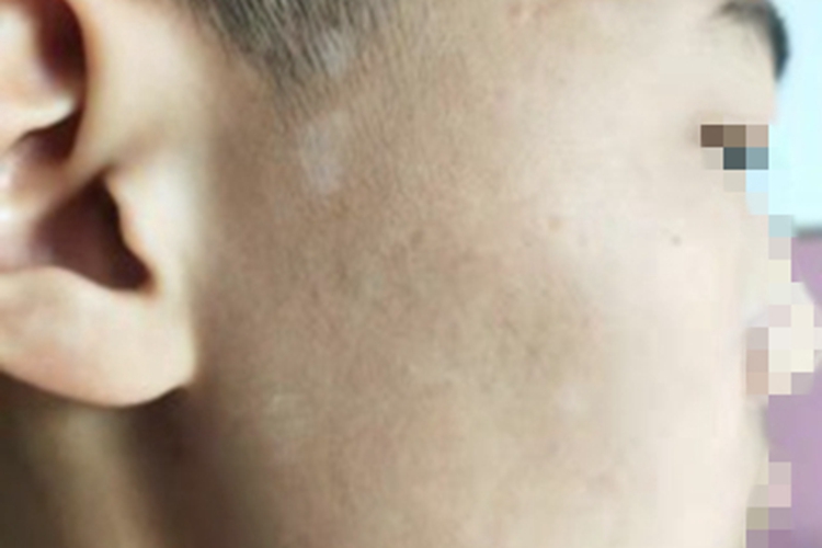 花斑糠疹面部白斑图 花斑糠疹面部白斑图