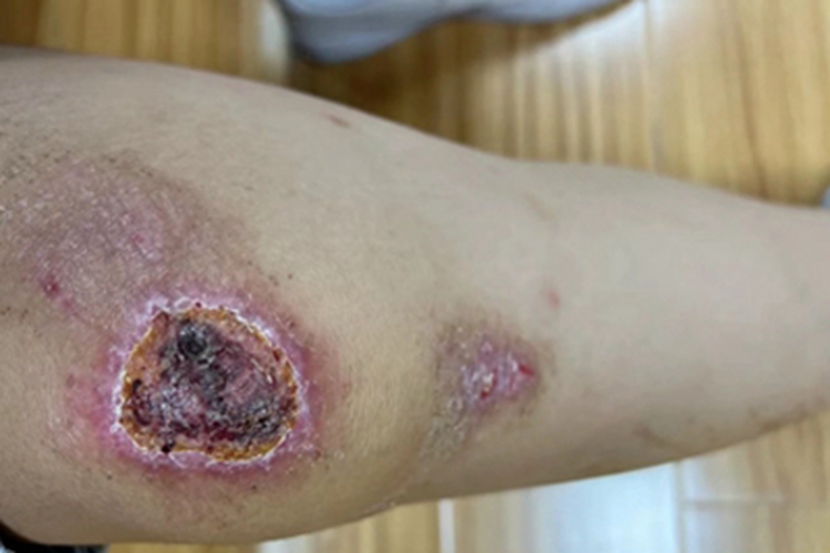 二度烫伤膝盖处有结痂图 二度烫伤膝盖处有结痂图