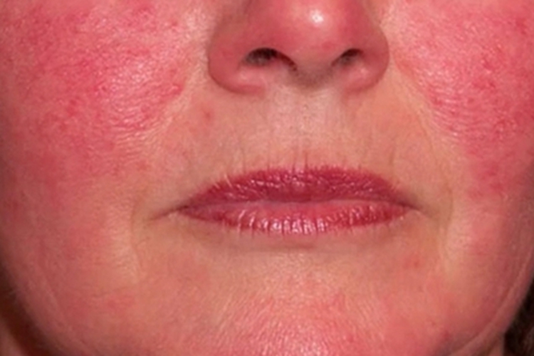 红斑毛细血管扩张型酒糟鼻红斑图 红斑毛细血管扩张型酒糟鼻红斑图