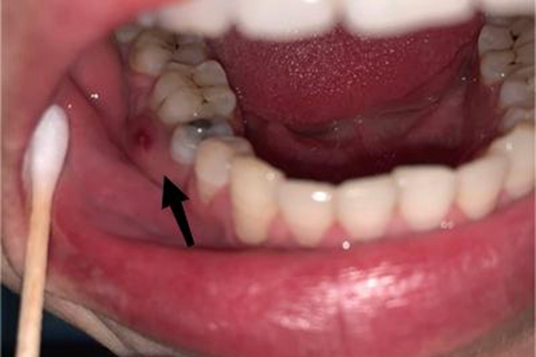 根尖周炎脓包图