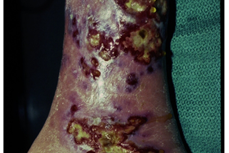 卡波西肉瘤斑块溃疡图