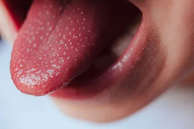 维生素B2缺乏症舌头症状图