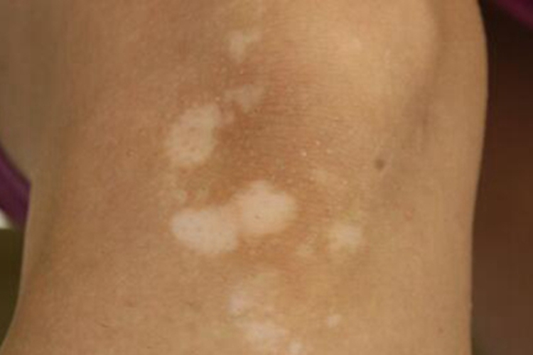 特发性点状色素减退斑白斑图