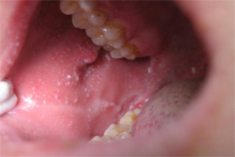 轻型麻疹口腔麻疹黏膜斑图 轻型麻疹口腔麻疹黏膜斑图