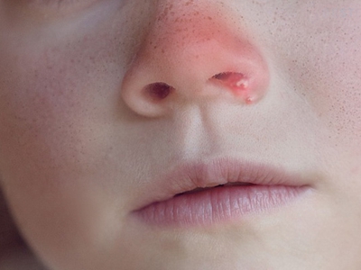 鼻疖鼻孔附近有小红包化脓图