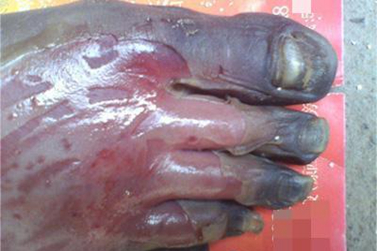 电弧烧伤脚趾发黑图 电弧烧伤脚趾发黑图