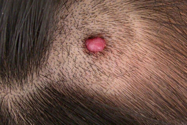 肉芽肿型血管瘤头上有肉疙瘩图