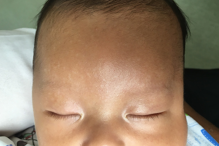 儿童花斑糠疹图