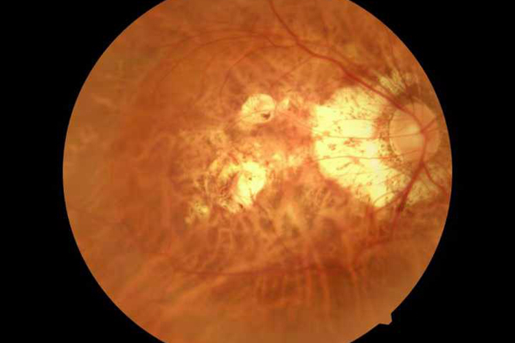 漆器裂纹样病变图