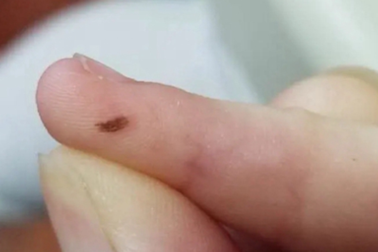 交界痣手指症状图 交界痣手指症状图