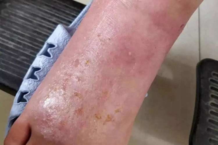 慢性接触性皮炎脚背症状图
