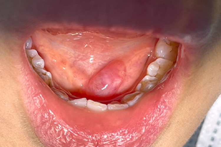 舌下腺囊肿口腔软包图