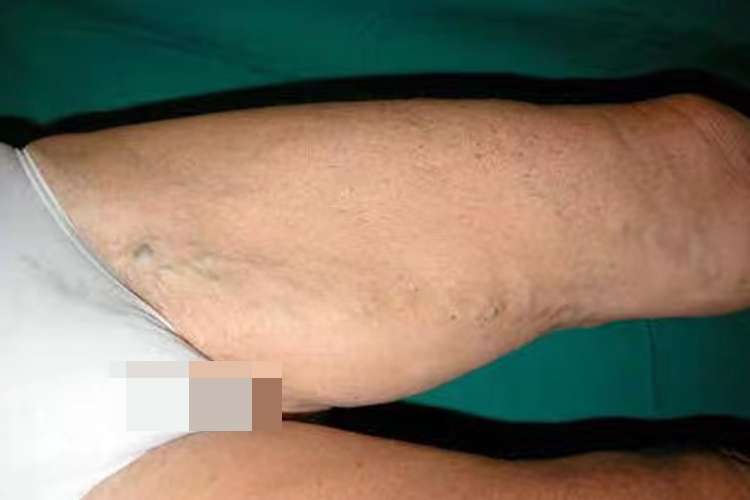 大腿根部静脉曲张初期图