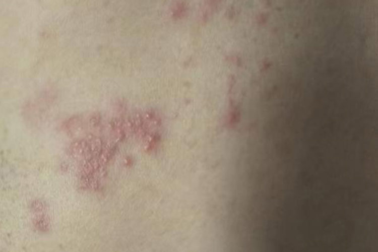 单纯疱疹的丘疹图