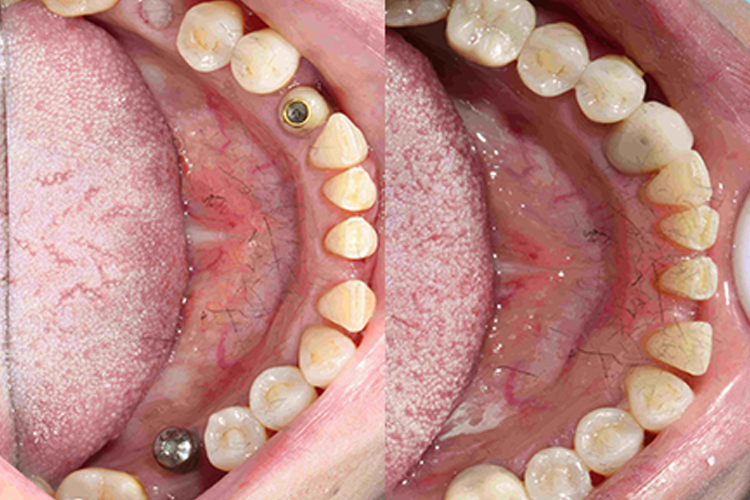 下牙种植牙效果图 下牙种植牙效果图