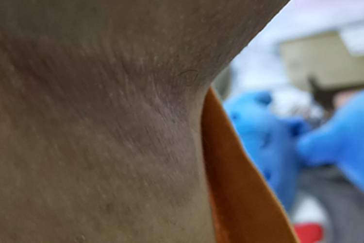 体癣腋窝下红色斑片图