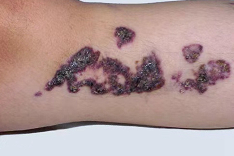 局限性血管角化瘤胳膊黑紫疙瘩图 局限性血管角化瘤胳膊黑紫疙瘩图