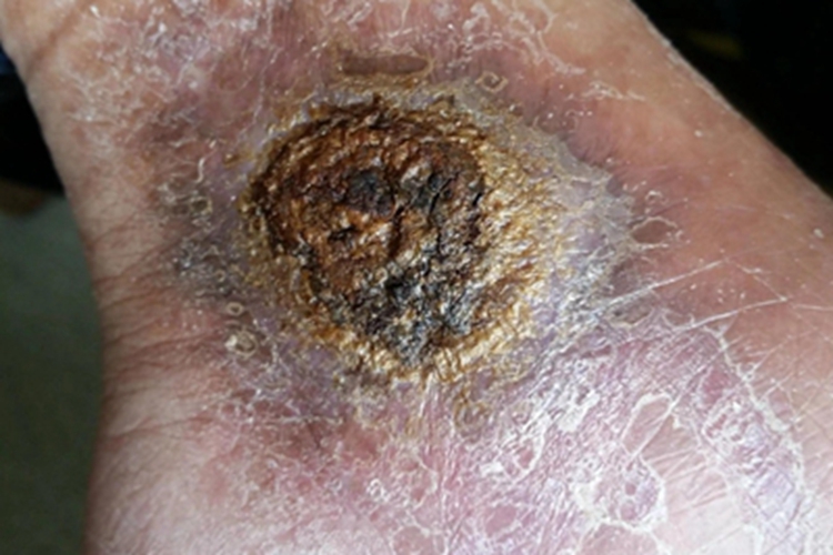 着色芽生菌病脚踝症状图 着色芽生菌病脚踝症状图