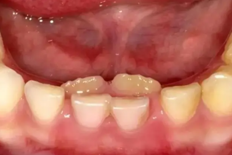 乳牙没掉恒牙长出来图