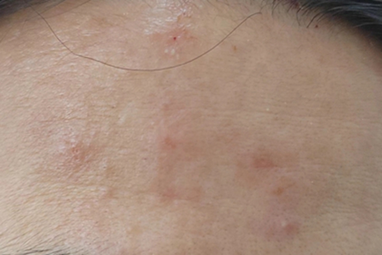 毛囊炎前额长了一片丘疹图 毛囊炎前额长了一片丘疹图