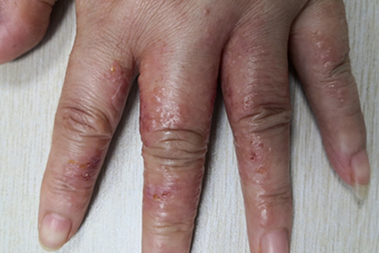 急性湿疹手指红斑水疱图