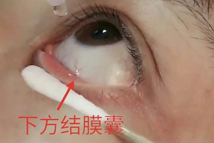 结膜囊位置图 结膜囊位置图