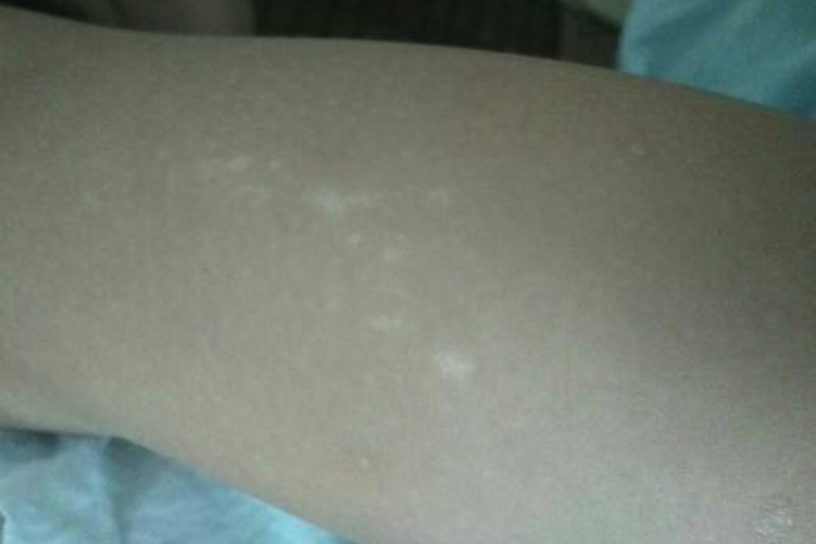 腿上白色糠疹小白点图