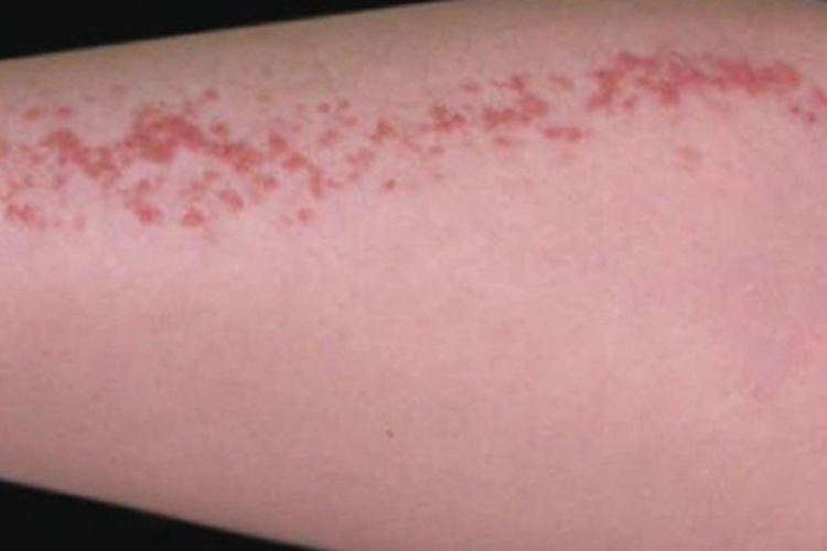 线状疣状表皮痣小腿丘疹图