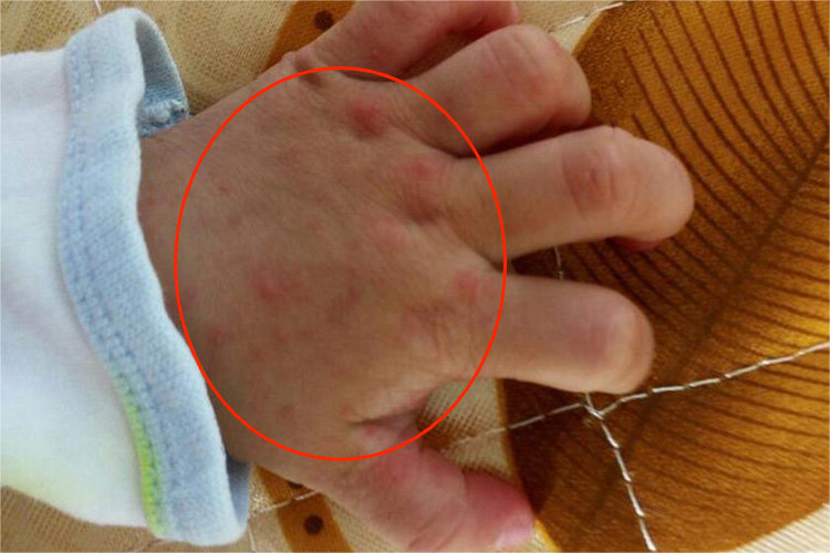 手上手足口病图